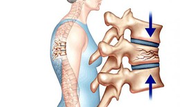 Chuy&#234;n gia cảnh b&#225;o hệ luỵ sức khoẻ do lo&#227;ng xương g&#226;y ra